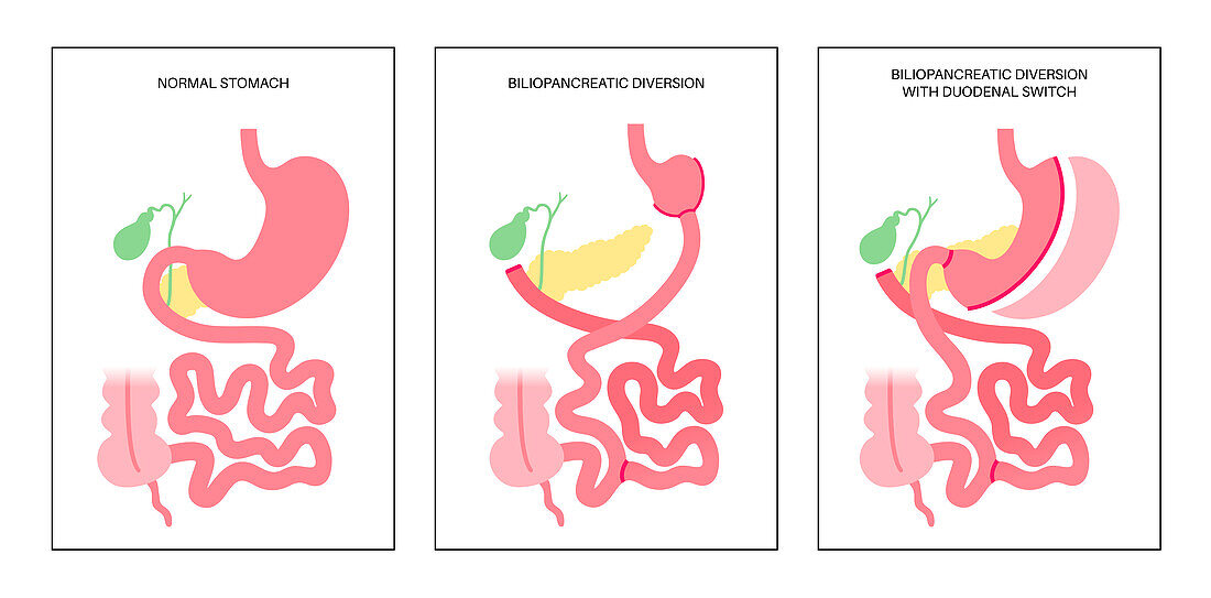 Biliopancreatic diversion procedure, illustration