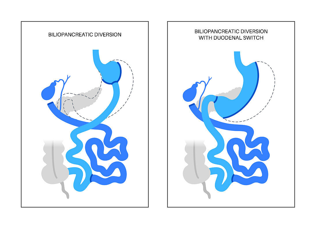 Biliopancreatic diversion procedure, illustration