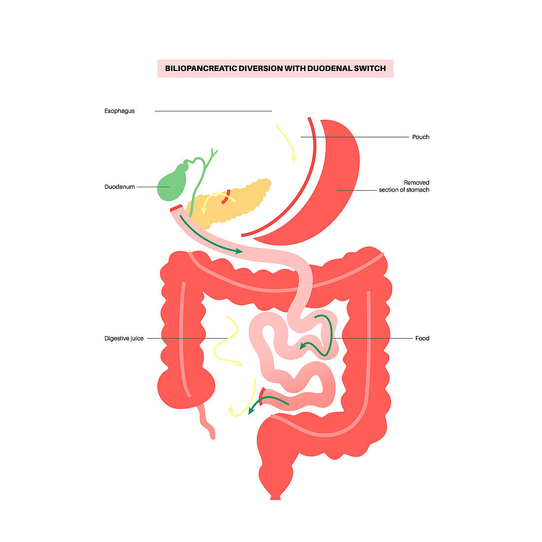 Biliopancreatic diversion procedure, illustration