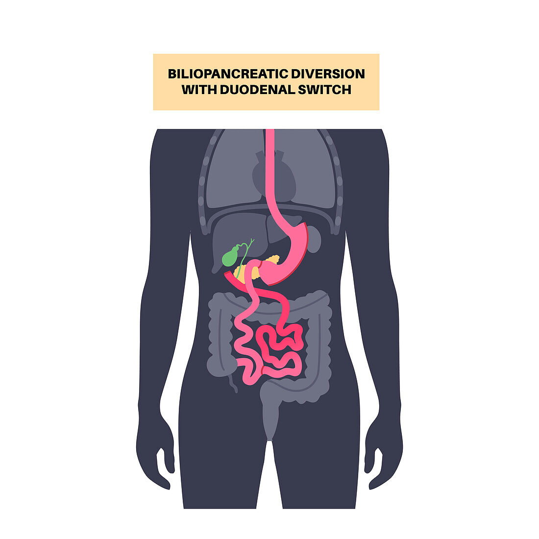 Biliopancreatic diversion procedure, illustration