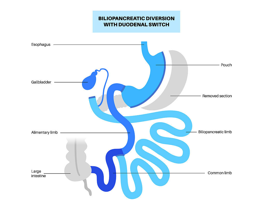 Biliopancreatic diversion procedure, illustration