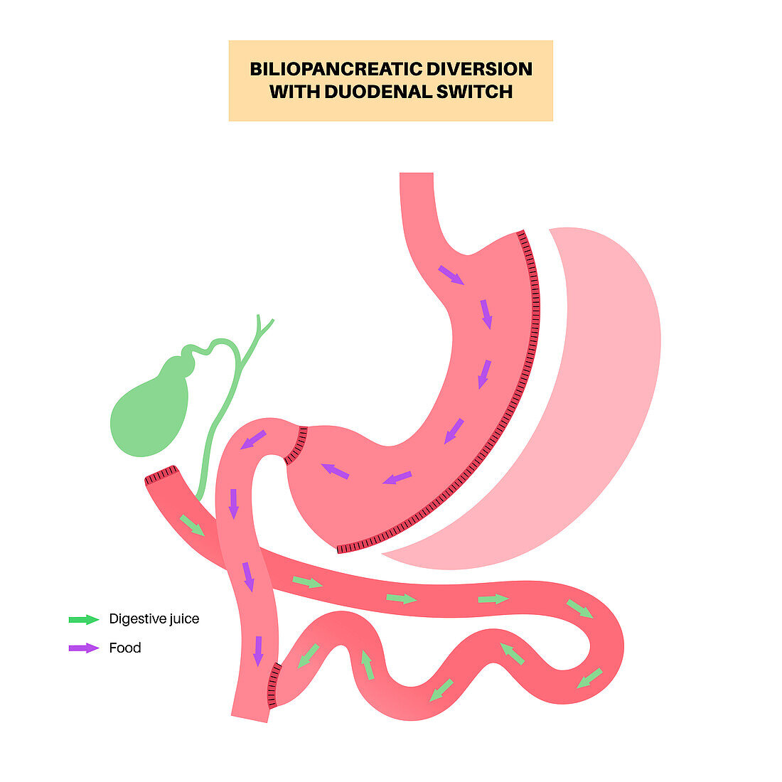 Biliopancreatic diversion procedure, illustration