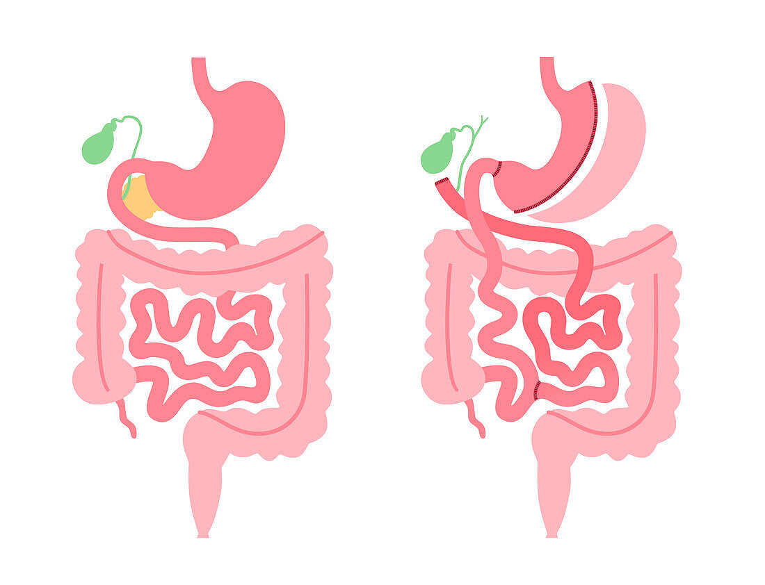 Biliopancreatic diversion procedure, illustration