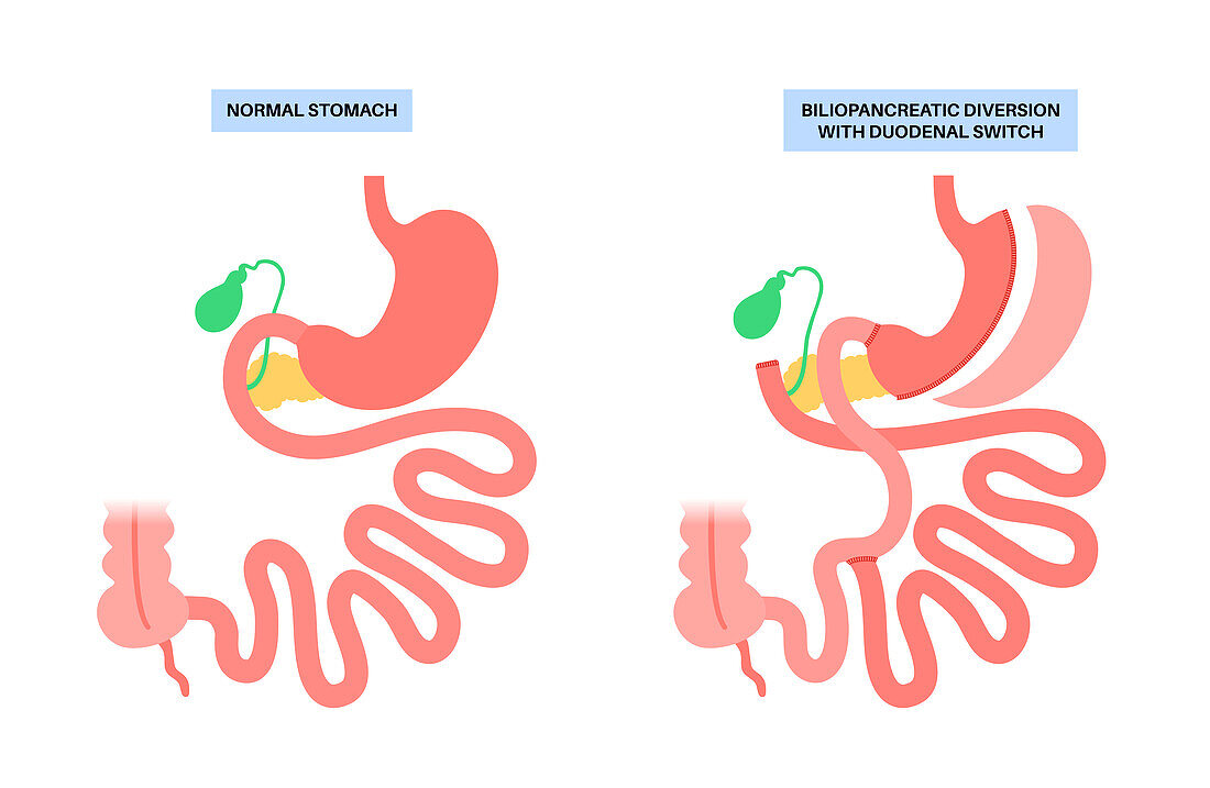 Biliopancreatic diversion procedure, illustration