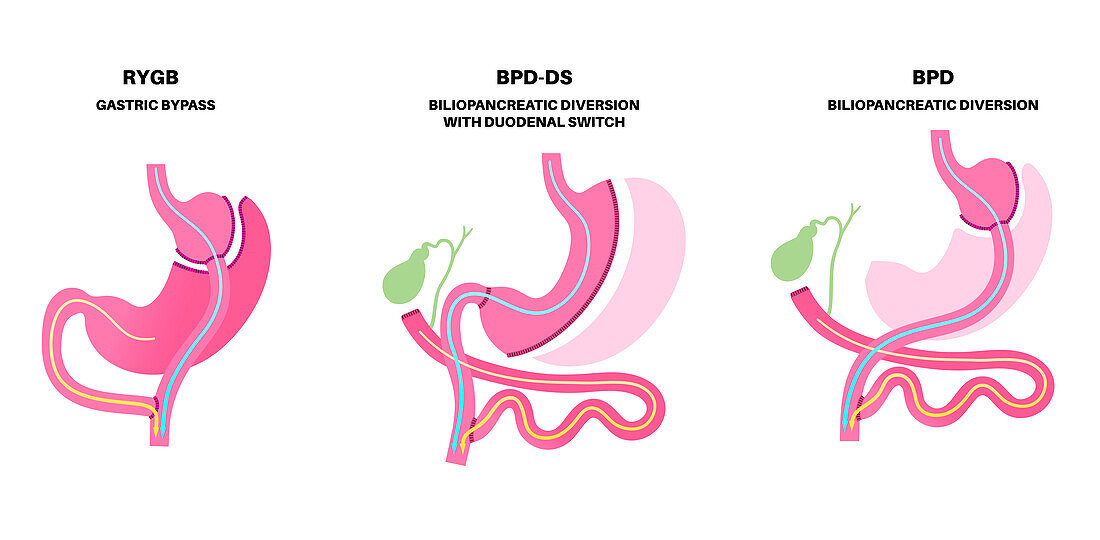 Types of bariatric surgery, illustration
