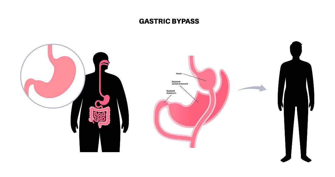 Gastric bypass surgery, illustration