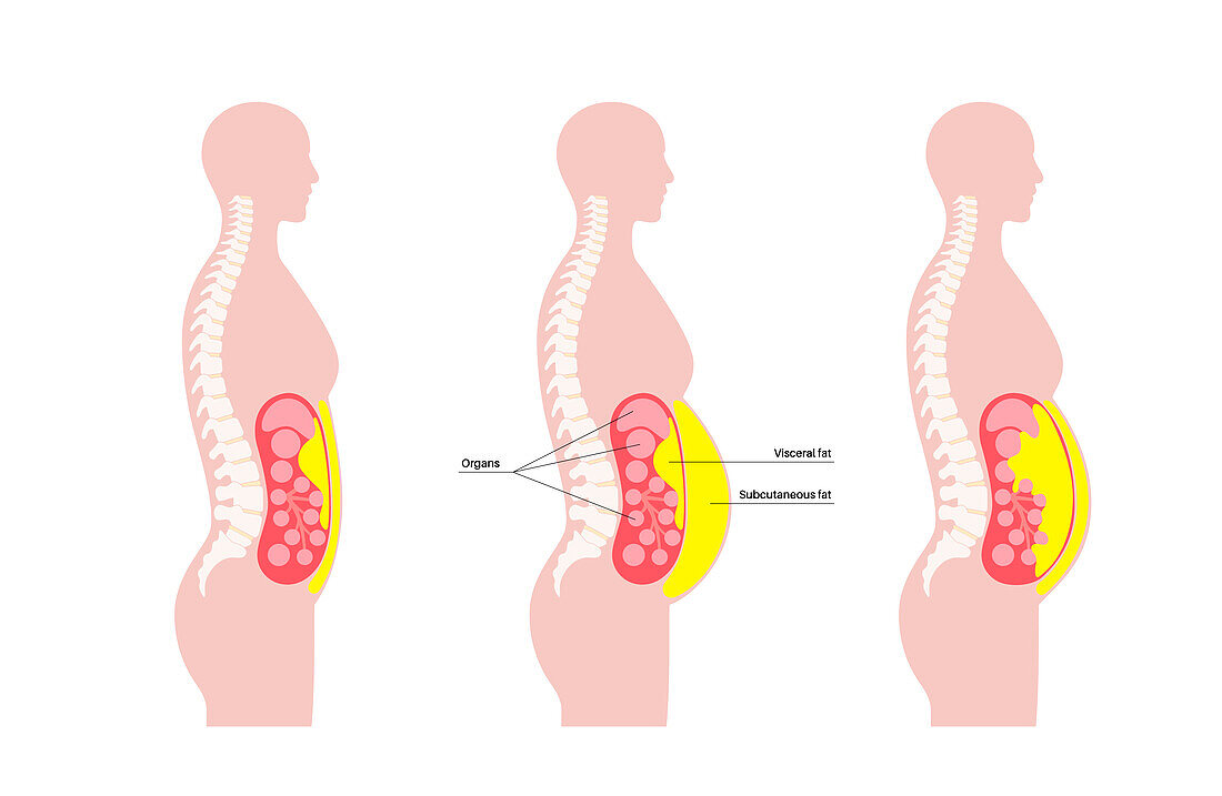 Visceral fat diagram, illustration