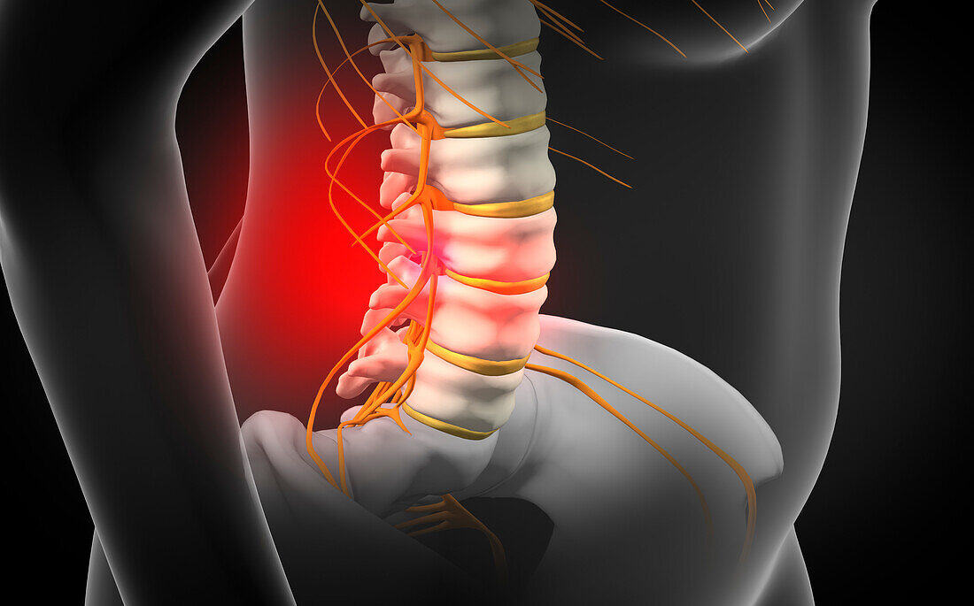 Spinal disc herniation, illustration