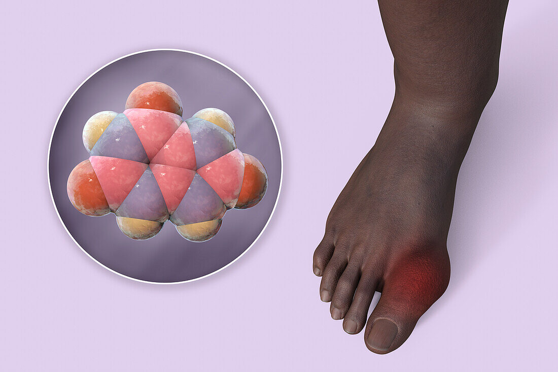 Gout-afflicted foot, illustration