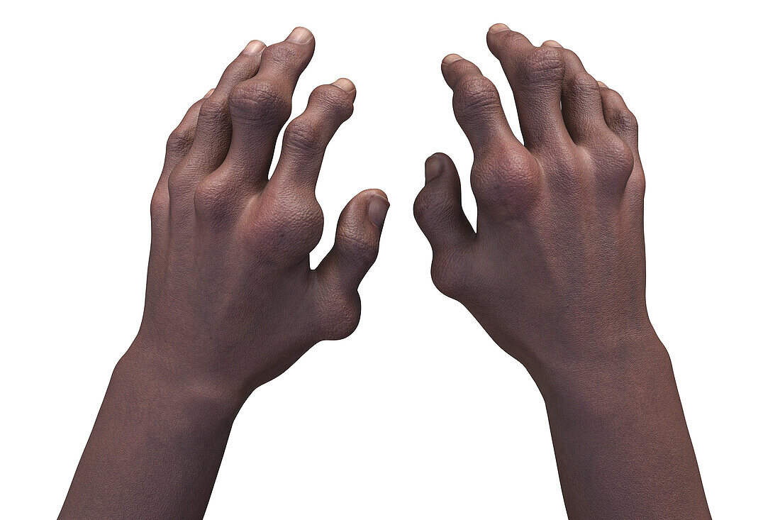 Gout-afflicted hands with deformities, illustration