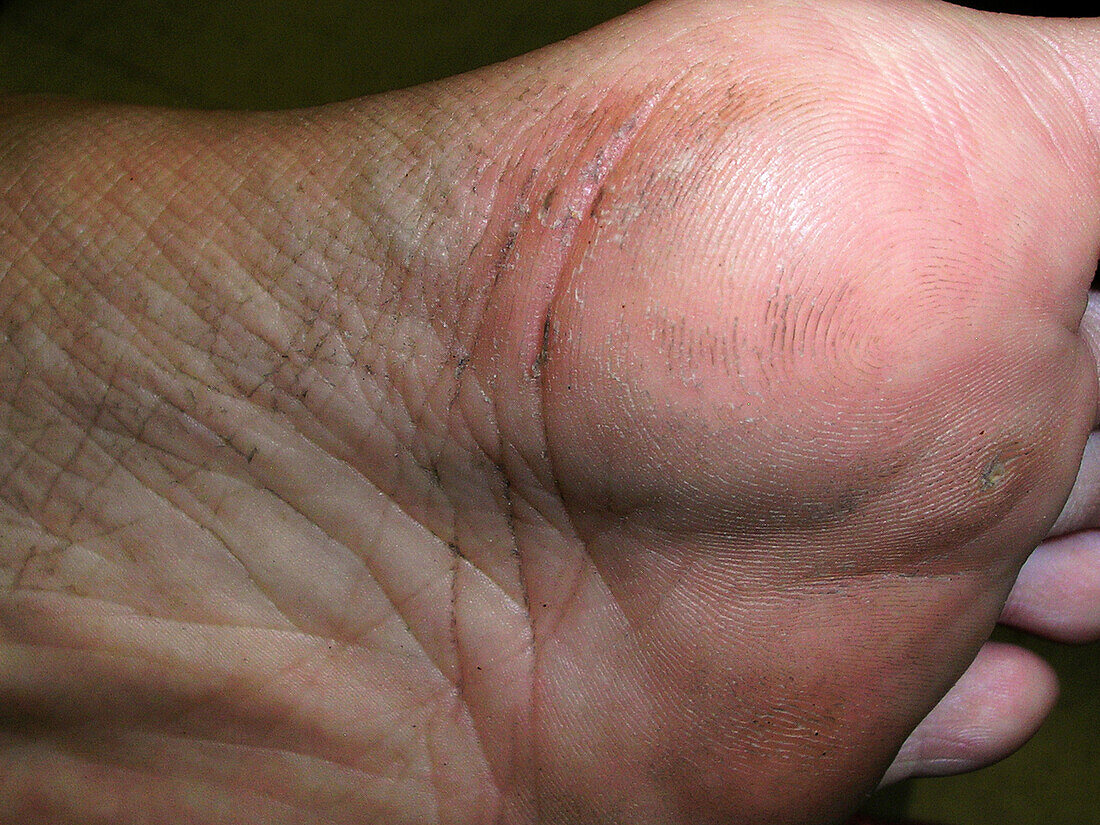 Terra-firma forme dermatosis