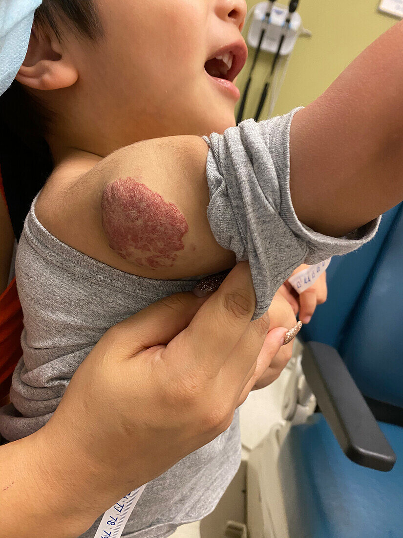 Infantile haemangioma