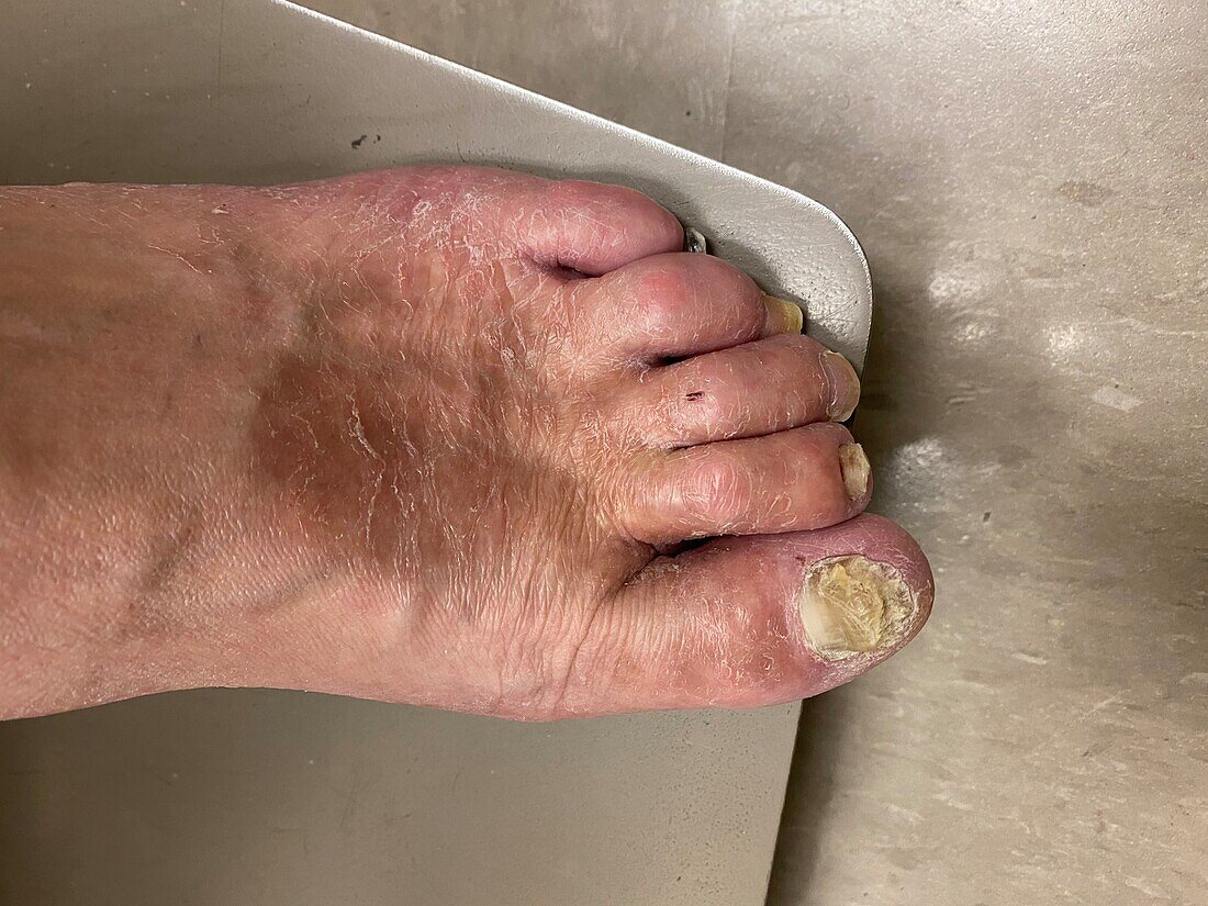 Athlete's foot