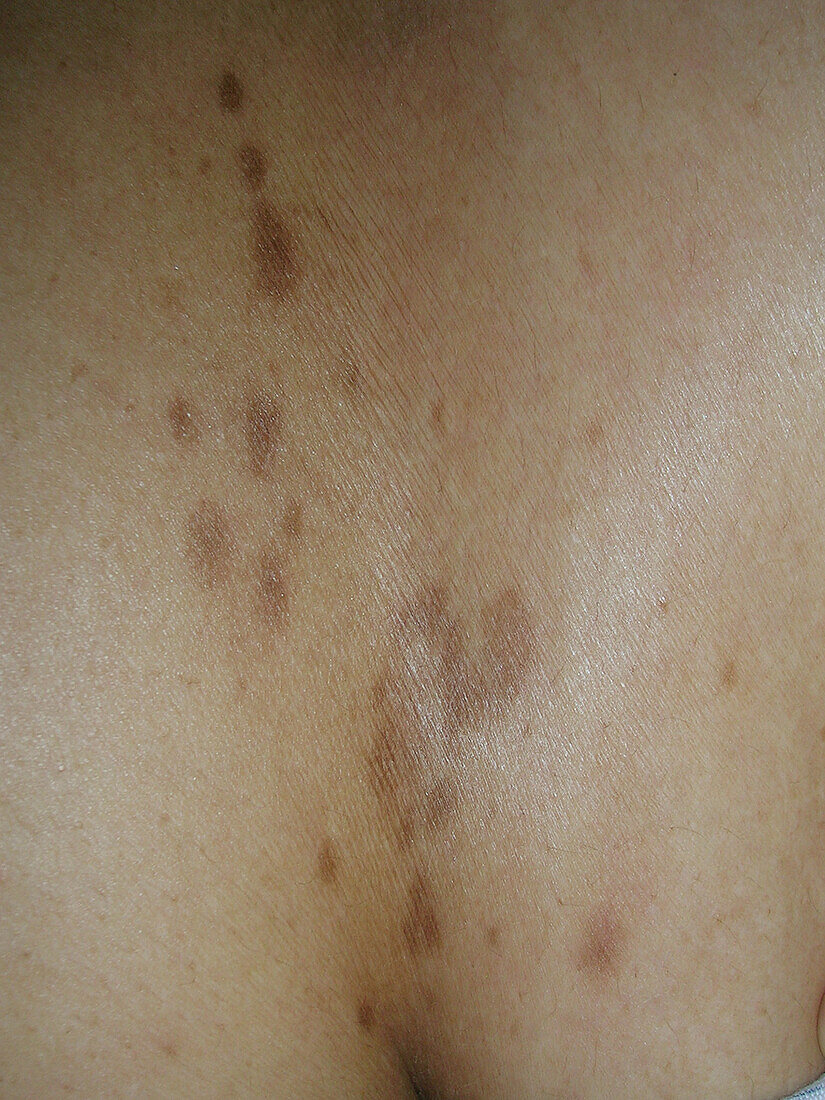 Ashy dermatosis