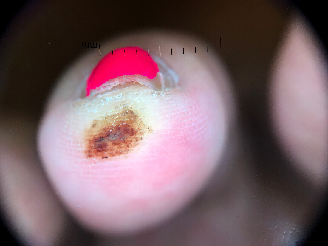 Haematoma, dermoscopy