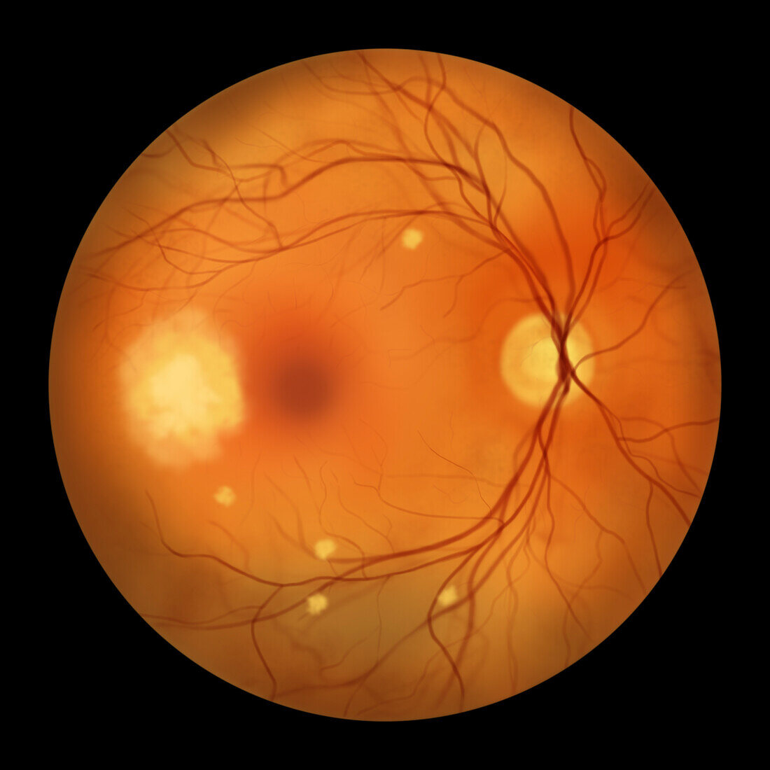 Retina affected by blastomycosis, illustration