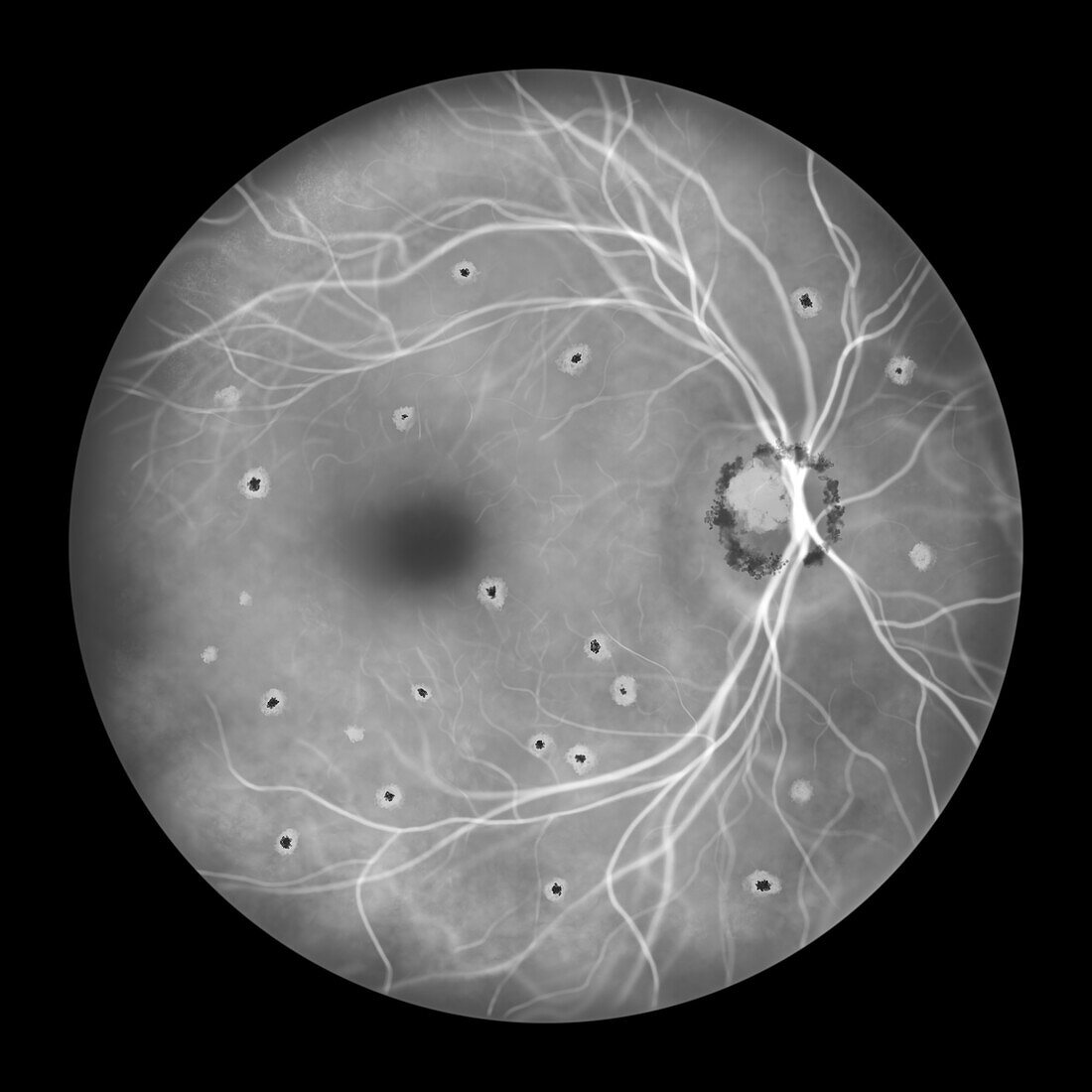 Retina affected by ocular histoplasmosis syndrome, illustration