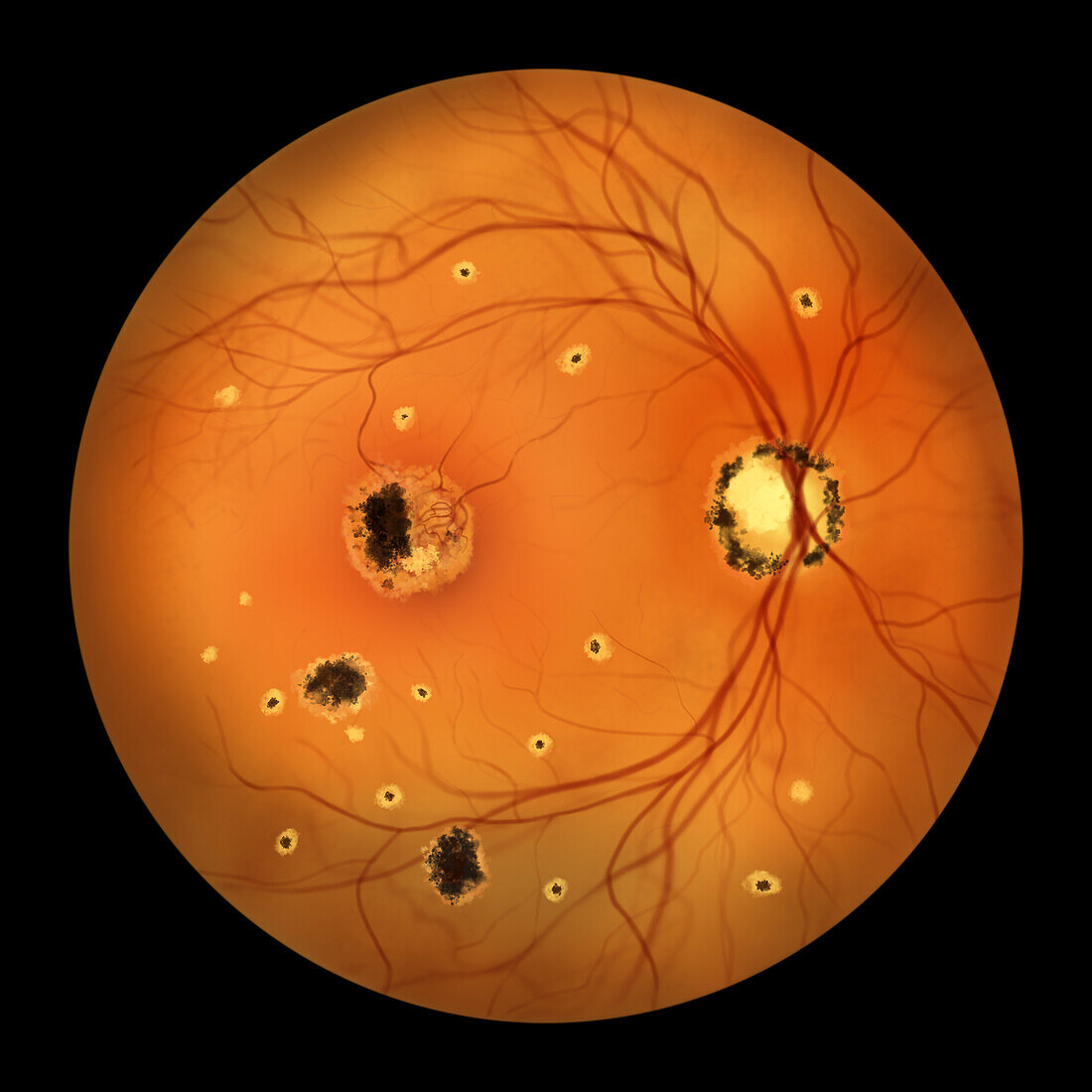 Retina affected by ocular histoplasmosis syndrome, illustration