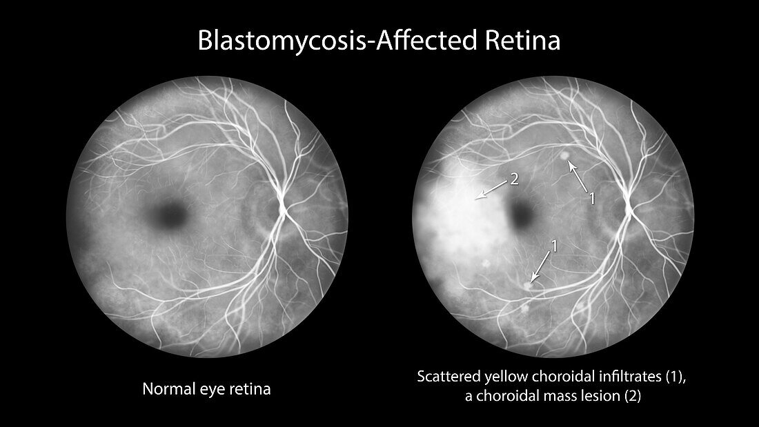 Retina affected by blastomycosis, illustration