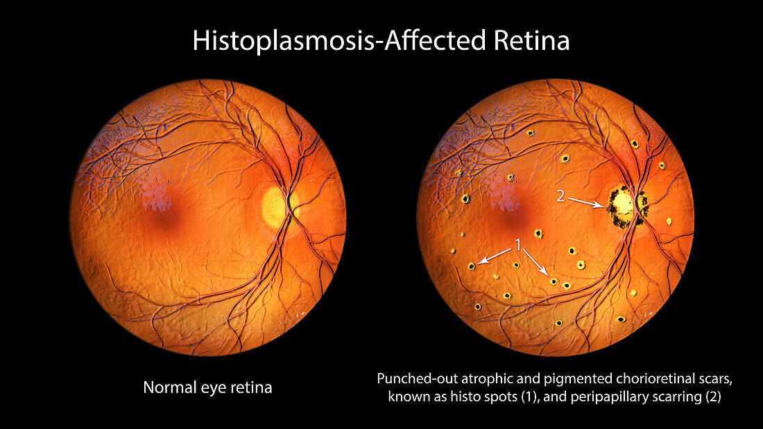 Retina affected by ocular histoplasmosis syndrome, illustration