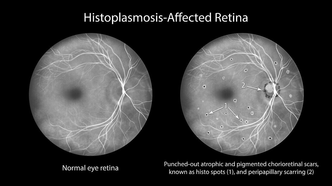 Retina affected by ocular histoplasmosis syndrome, illustration