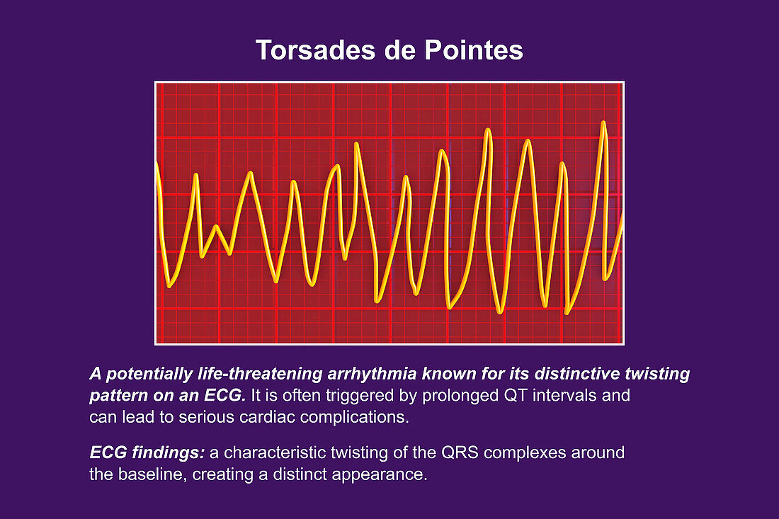 ECG displaying Torsades de pointes rhythm, illustration