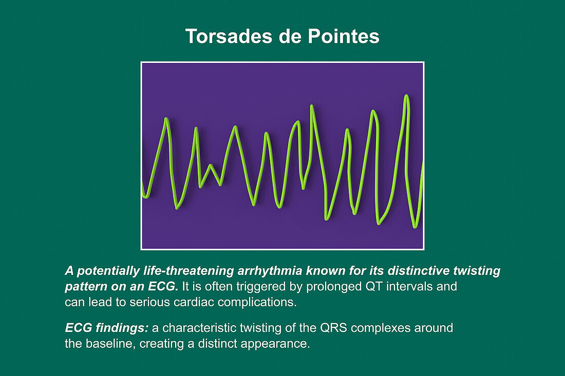 ECG displaying Torsades de pointes rhythm, illustration