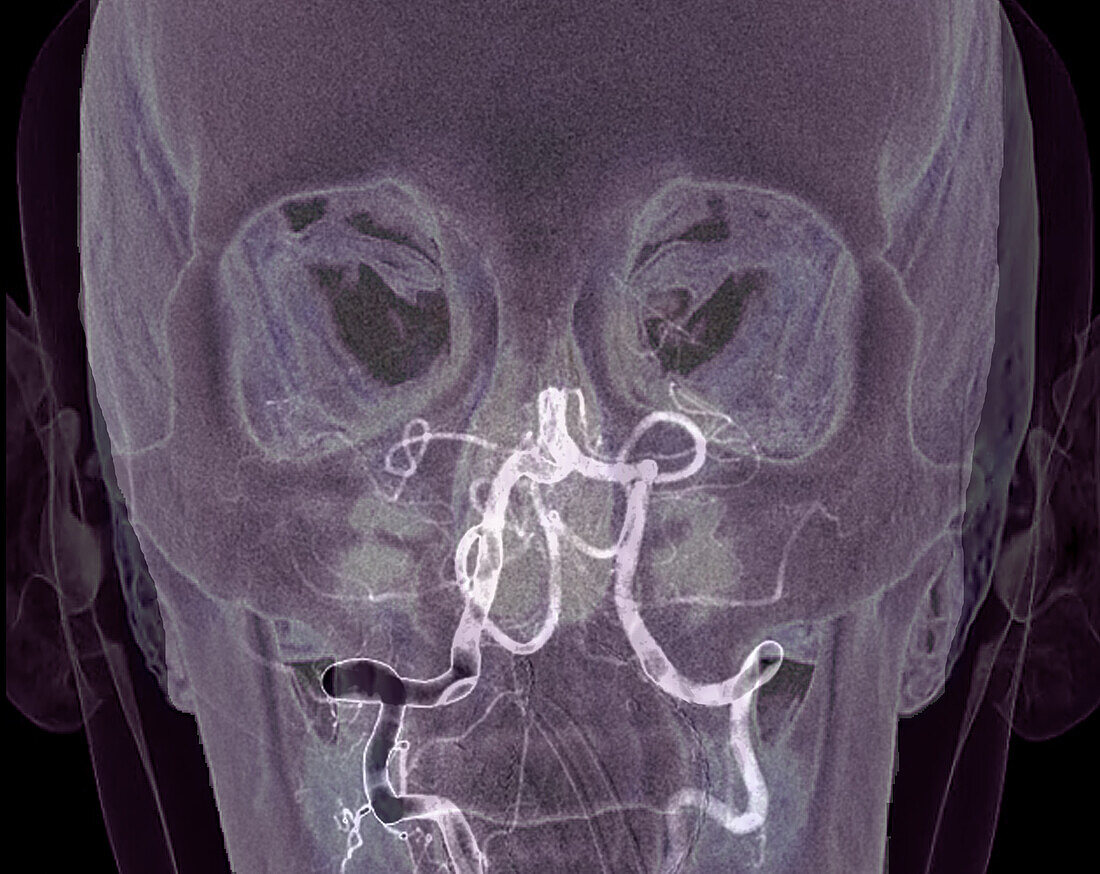 Ischaemic stroke, CT scan