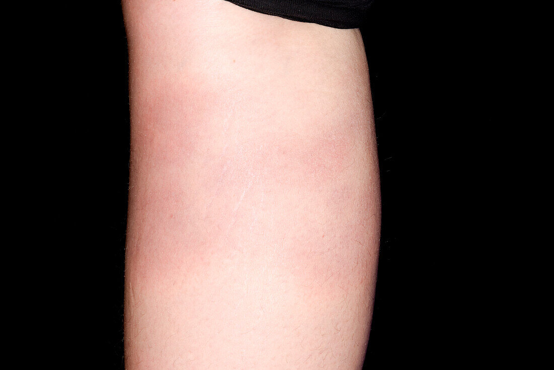 Lyme's disease rash