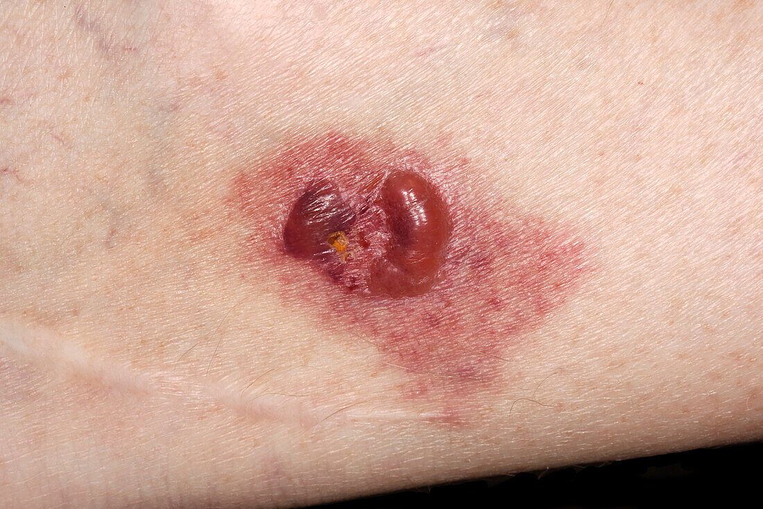 Insect bite reaction