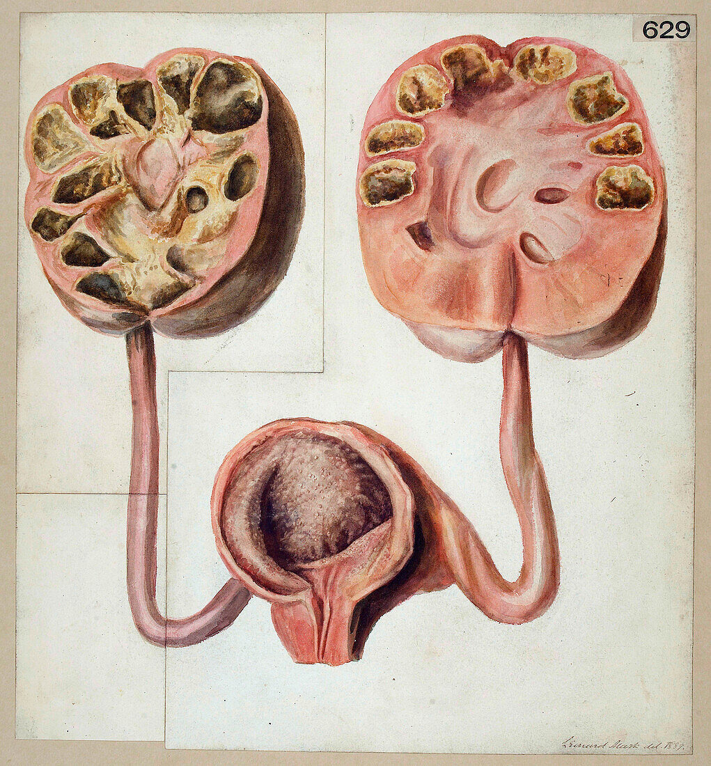 Kidneys and bladder with tuberculosis, 19th century illustration