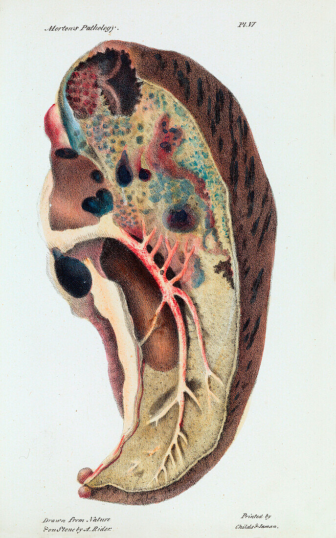 Lung infected with tuberculosis, 19th century illustration