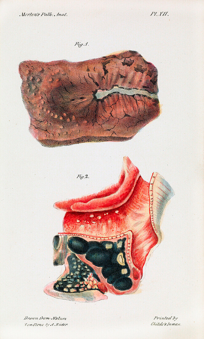 Lung sections infected with tuberculosis, 19th century illustration