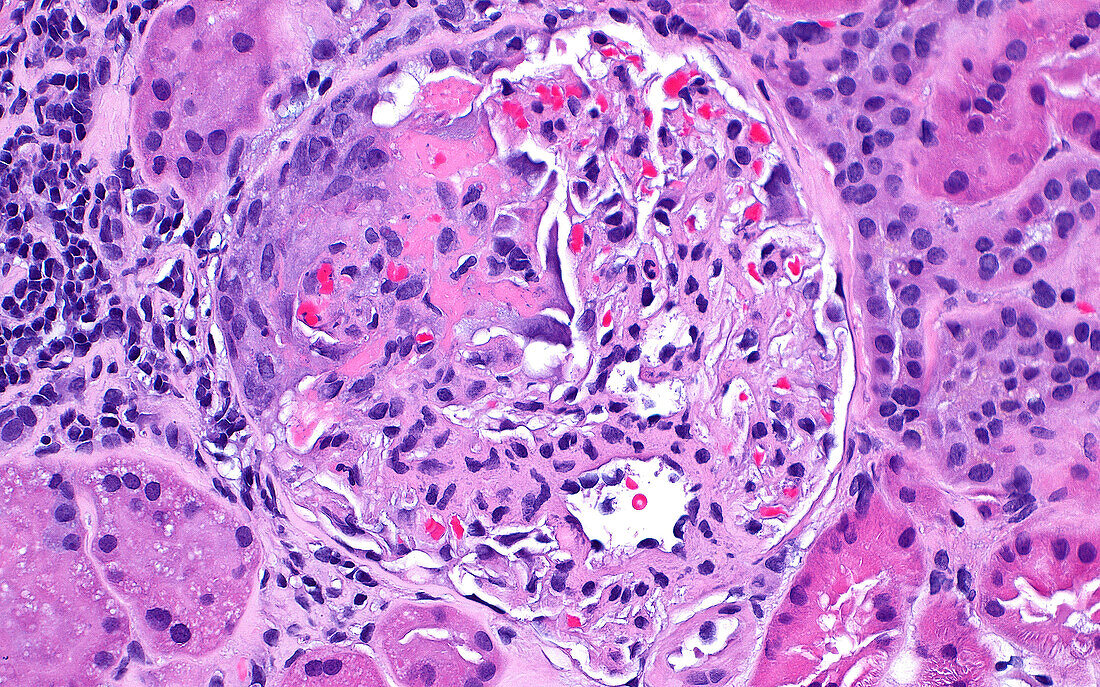 Glomerulus crescent, light micrograph