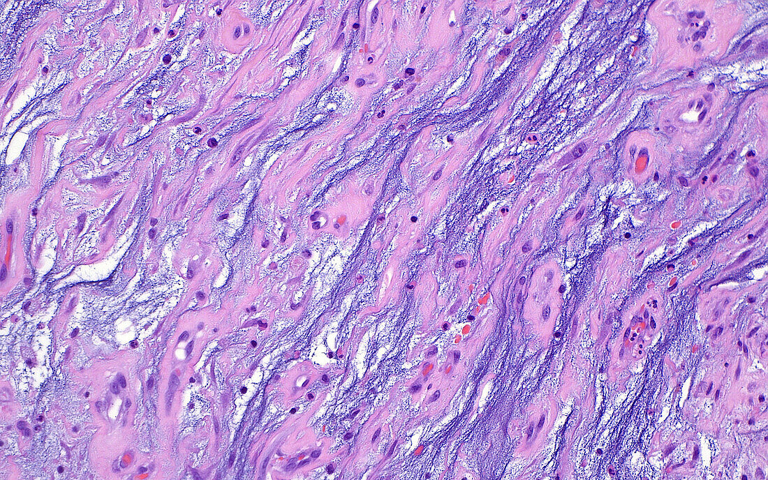 Granulation tissue, light micrograph