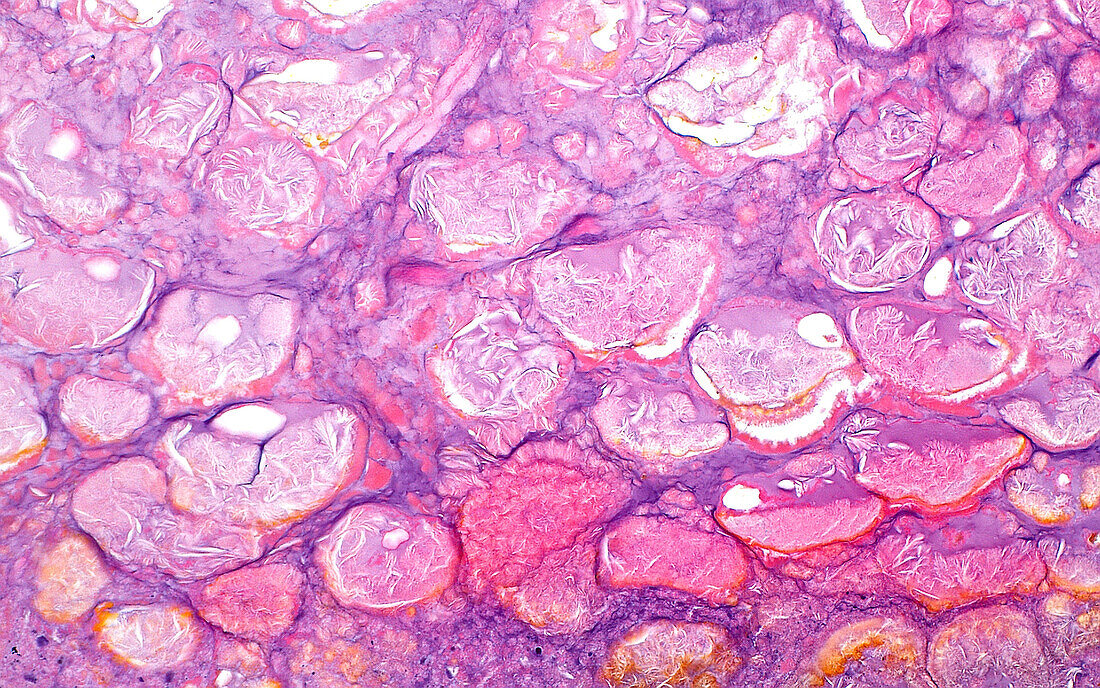 Saponification fat necrosis, light micrograph