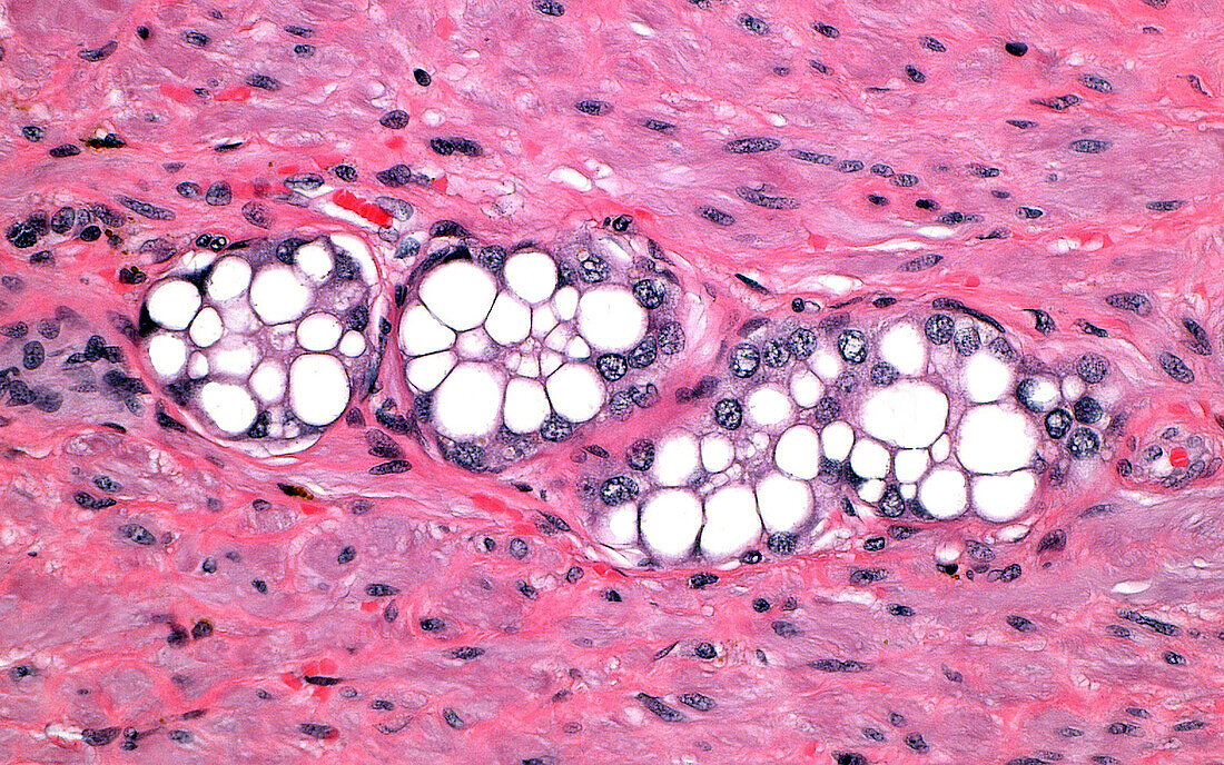 Prostate cancer vacuolated cells, light micrograph