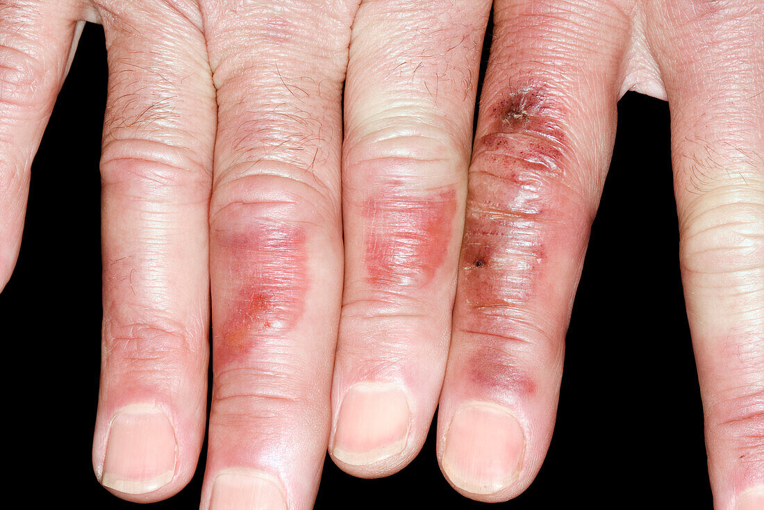 Chilblains on the fingers