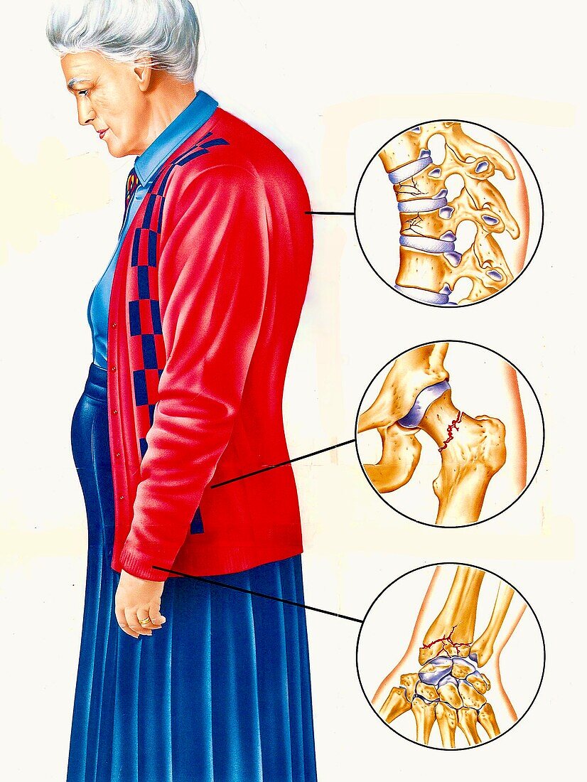 Common osteoporosis fractures, illustration