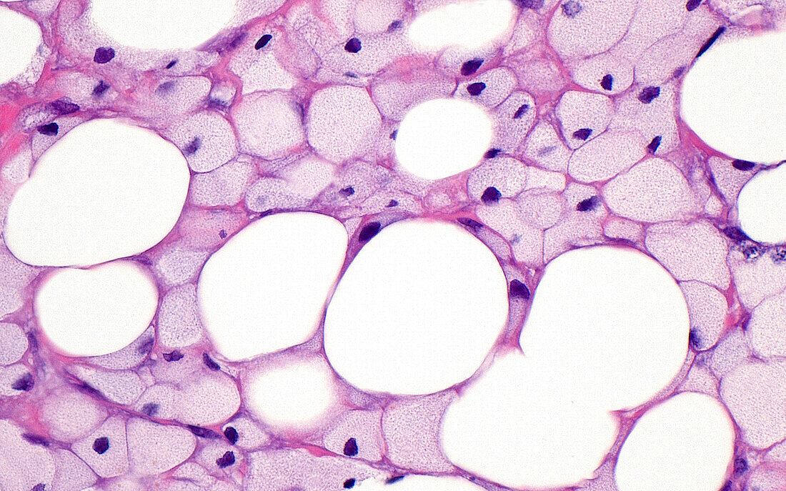Fat necrosis, light micrograph