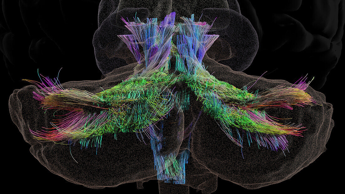 Superior and inferior cerebellar peduncles, DTI MRI scan