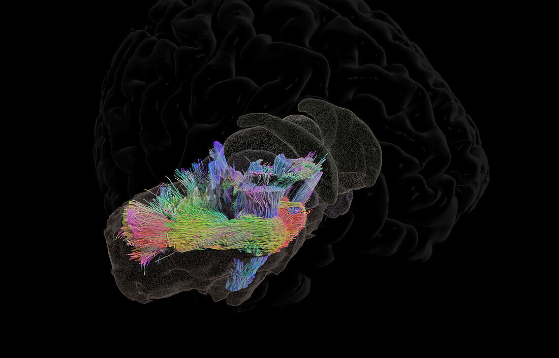 Brainstem white matter fibres, DTI MRI scan