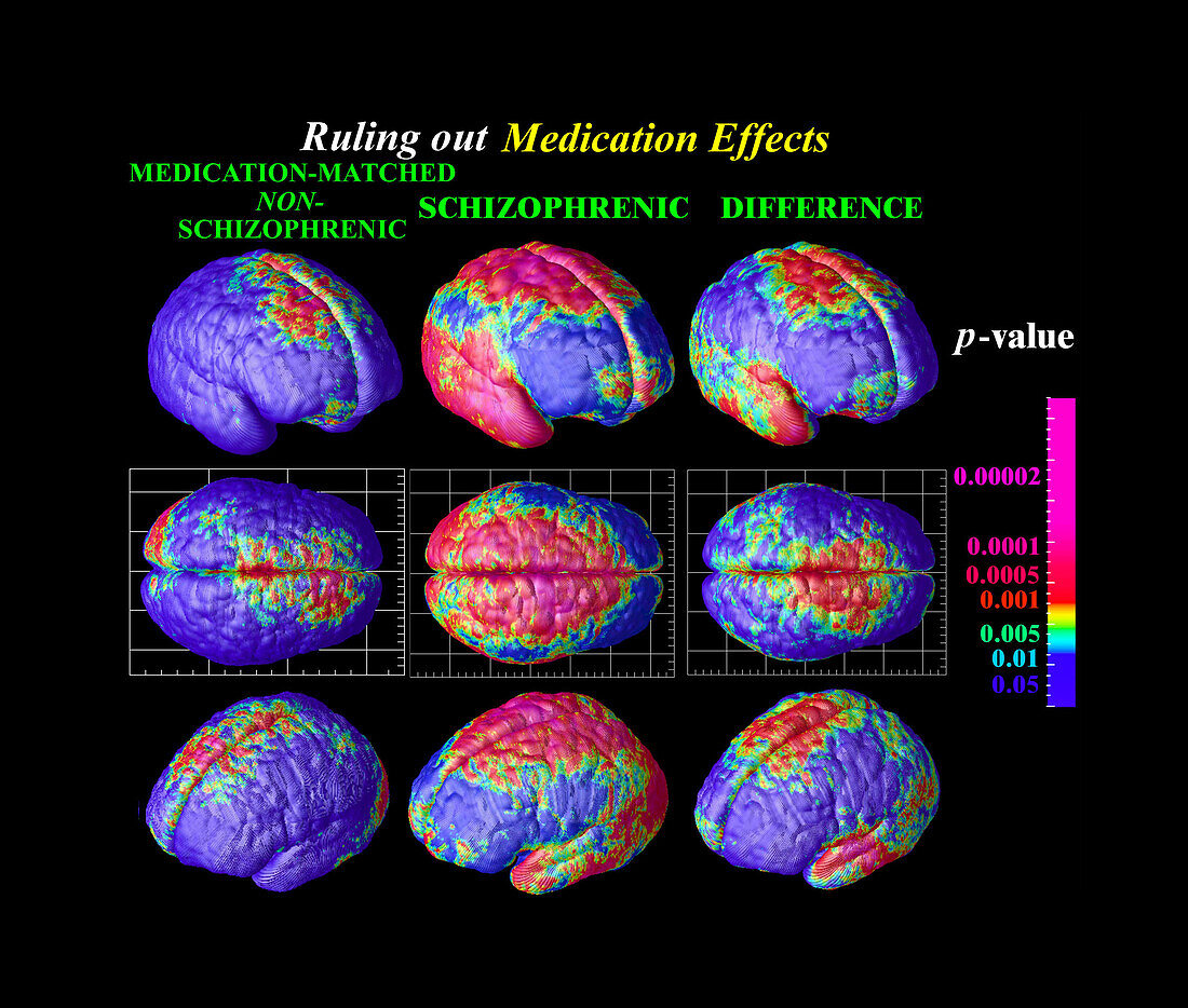Grey matter loss in very early-onset schizophrenia, brain maps