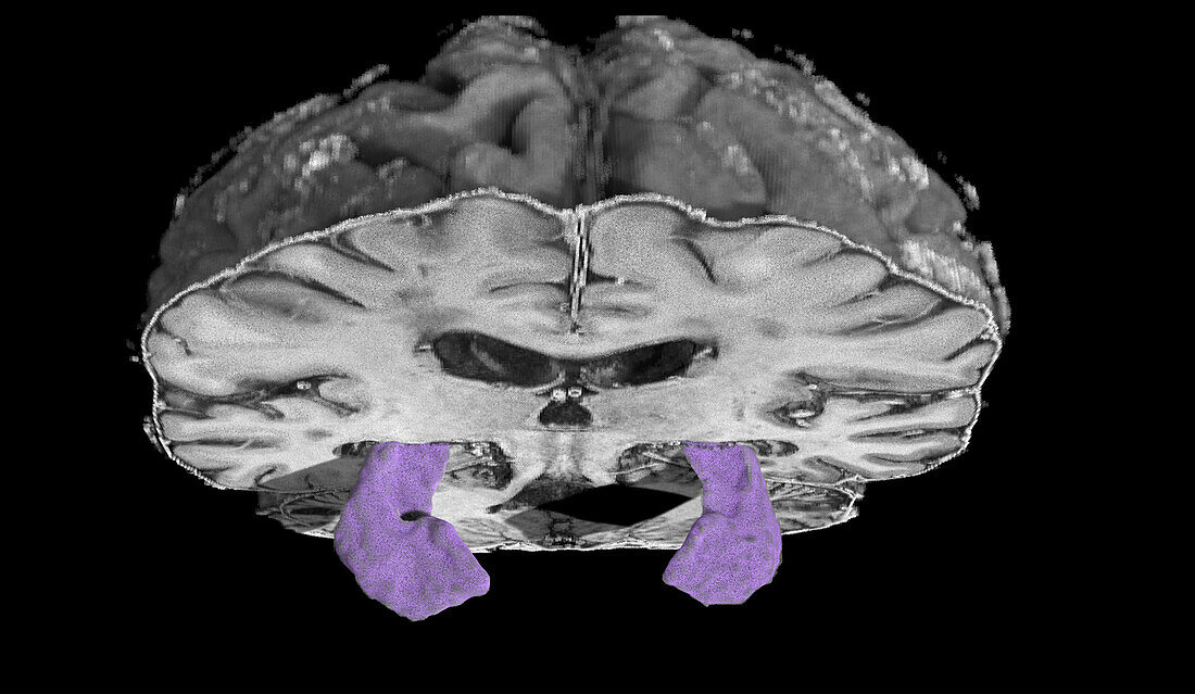 Atrophied hippocampi, MRI scan