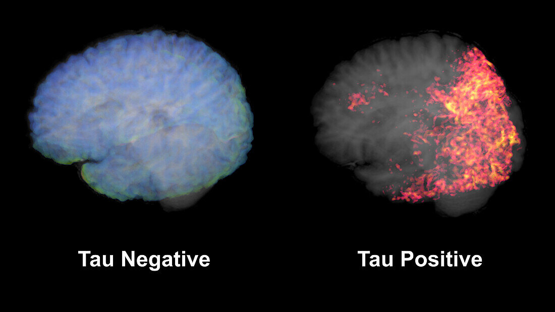 Healthy brain and brain with tau aggregations, MRI scans