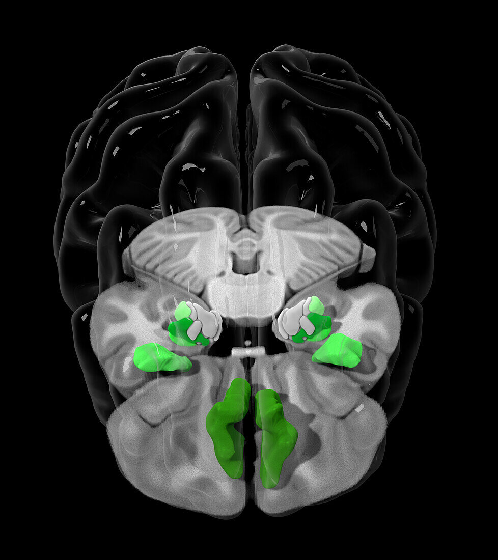 Brain areas affected by THC exposure, MRI scan