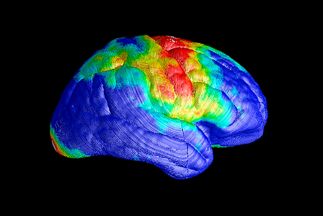 Brain tissue loss in AIDS, MRI scan