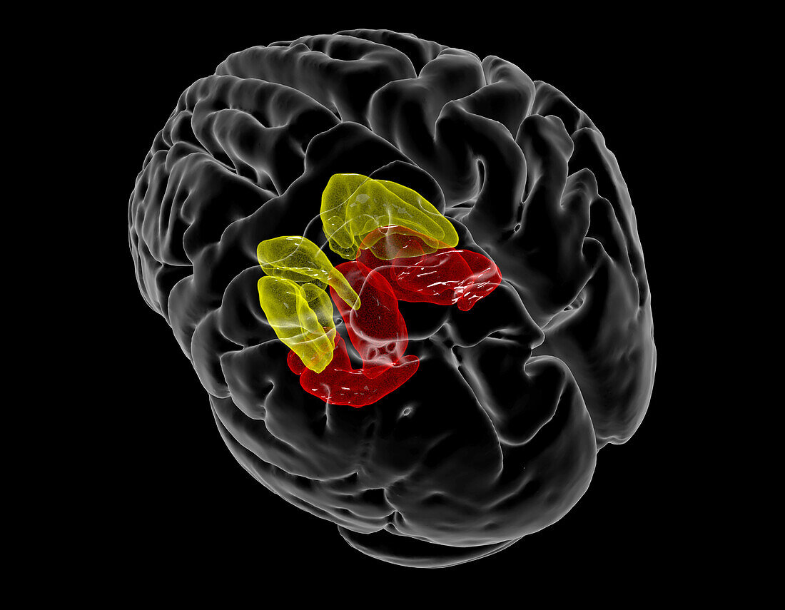 Brain areas affected by HIV, MRI scan