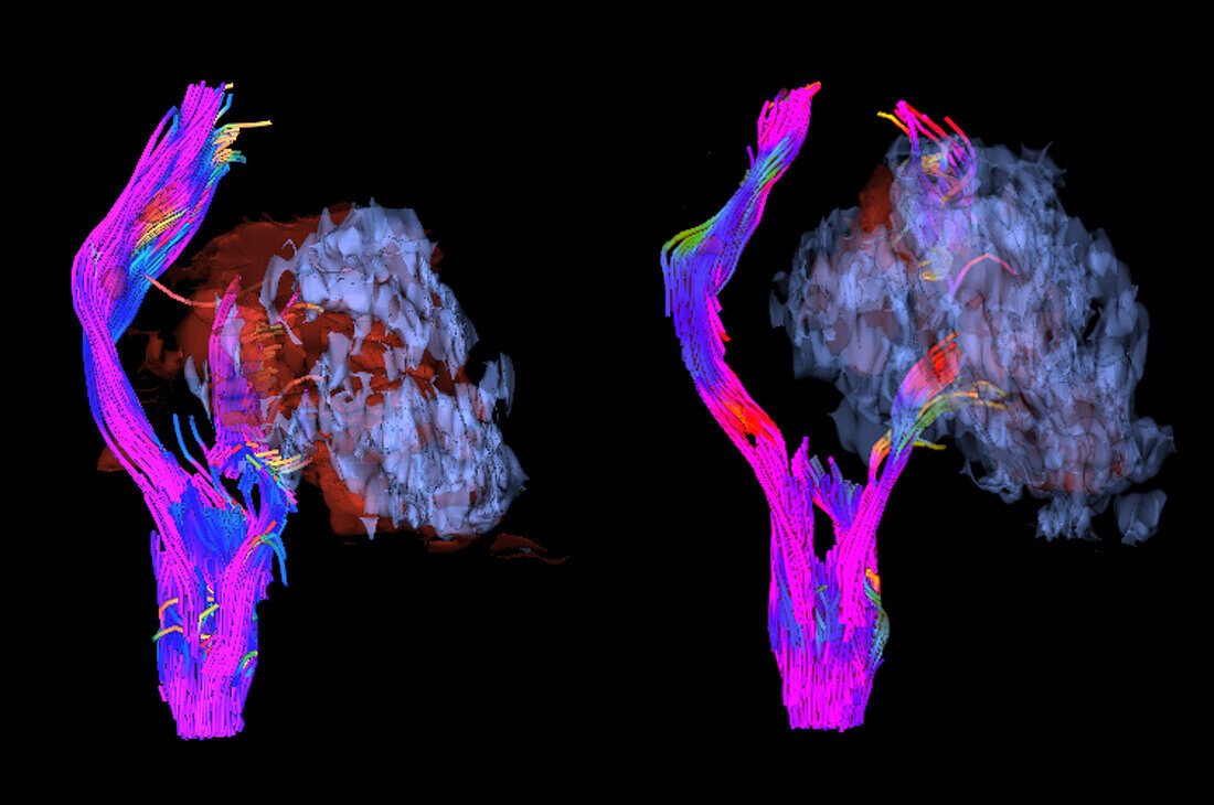 Acute and chronic brain haemorrhage, DTI MRI scan