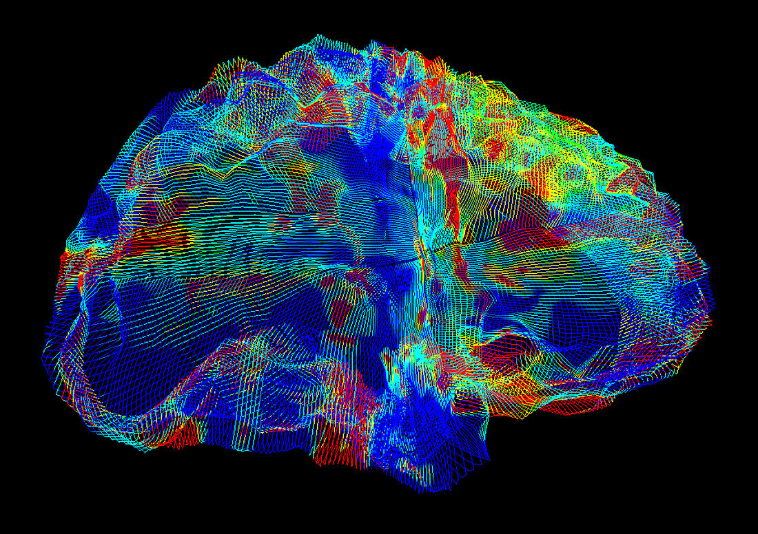 Brain in Alzheimer's disease, DTI MRI scan